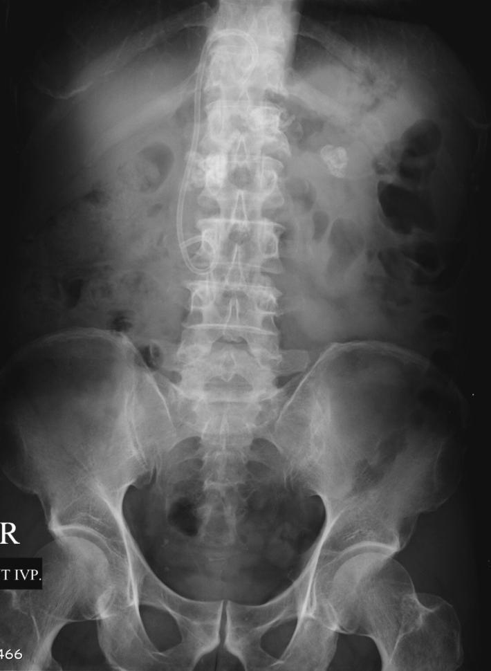 Chronic pancreatitis Radiography Calcifications projecting over