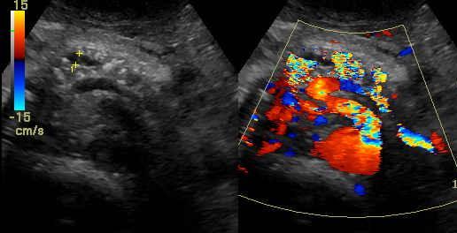 Chronic pancreatitis Ultrasound findings Pancreatic calcifications (40%), may