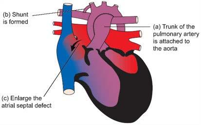 (II) HLHS: A Single-ventricle Defect (II.