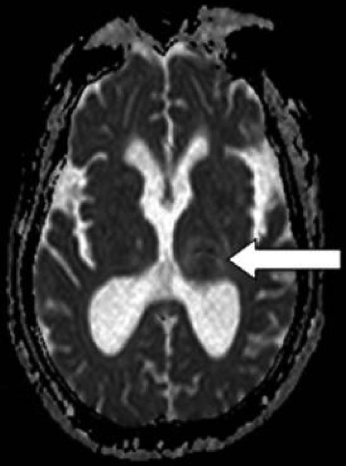 Each arrow shows restricted diffusion in the left thalamus. A B solute bed rest. She developed dysarthria and right hemiparesis.