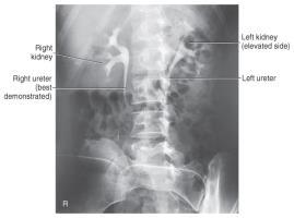plane of IR Downside: Ureter is free of superimposition from spine Entire