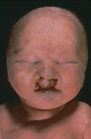 Trisomy 13 Small head (microcephaly) Gross anatomic defects of the brain