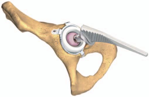 The gun impaction plate assists correct positioning of the femoral head into the insert.