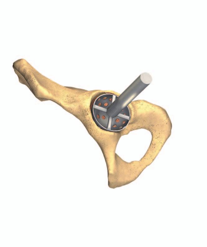 SURGICAL TECHNIQUE Acetabular Preparation The acetabulum is prepared by: Excision of the labrum. Optional resection of the transverse acetabular ligament (TAL).