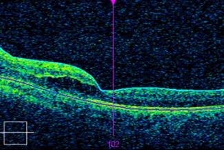 the optic disc spread of edema into macula