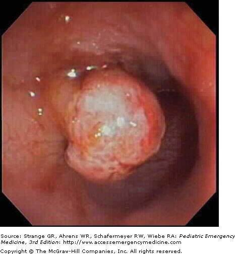 A 0.7-cm pedunculated polyp was identified in the sigmoid colon of a child presenting with painless rectal bleeding. (Photo courtesy of Dr.