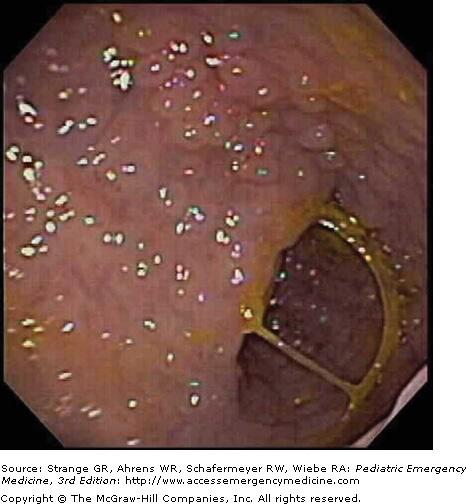 Diffuse lymphnodular hyperplasia is seen in this child undergoing colonoscopy for rectal bleeding. (Photo courtesy of Dr.