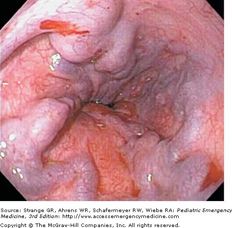 junction or in the cardia of the stomach. Abdominal pain is typically minimal.