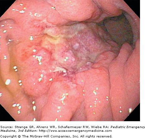 Gastritis and peptic ulcer disease are common etiologies for upper gastrointestinal bleeding (Fig. 72 2).