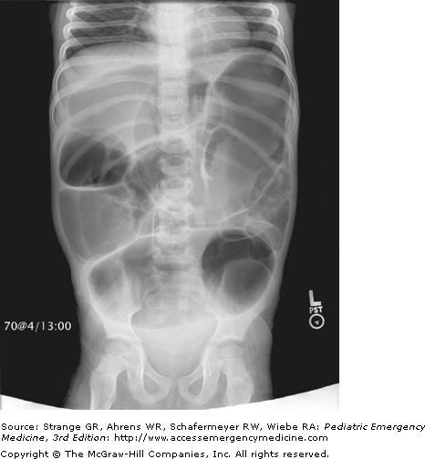Intestinal cutoff sign seen in a child with toxic megacolon. This child had previously undergone resection of his aganglionic colon segment. Note the massive intestinal distension.