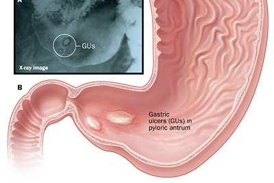 Peptic Ulcer Disease - Diagnosis (1)