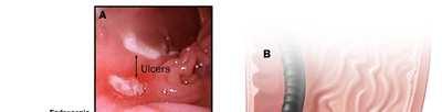 Peptic Ulcer Disease -