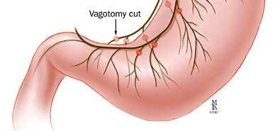 Surgery Vagotomy