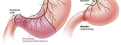 Peptic Ulcer Disease - Therapy