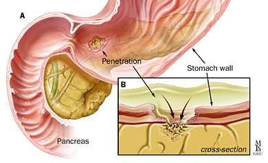 of perforating ulcers pancreas,
