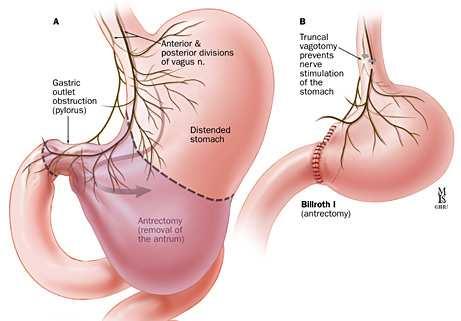 gastric ulcer endoscopic