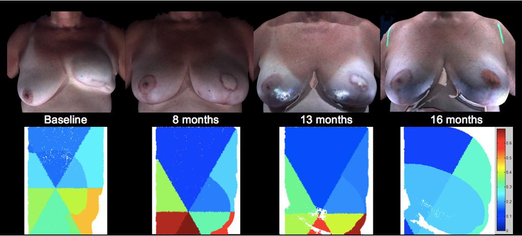 Figure 3. Patient A s 3D surface images of the TRAM reconstructed left breast from preoperative to 9 months postoperative (top row).