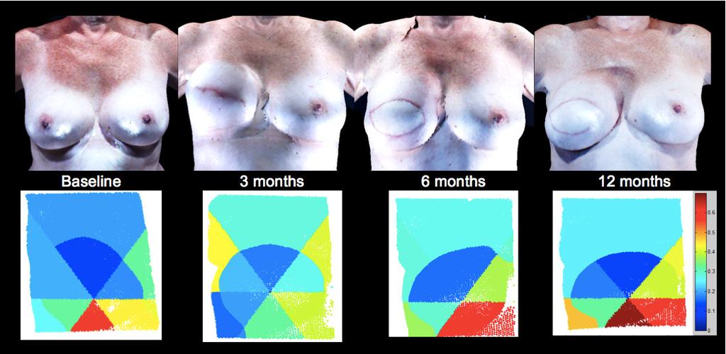 Patient B s images of the TRAM reconstructed right breast from baseline to 12 months postoperative (top row).