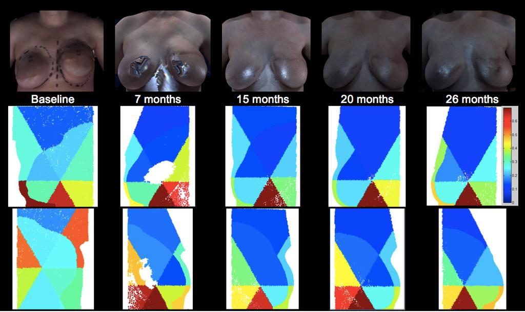 Figure 5. Patient C s Images of the TRAM reconstructed right breast from baseline to 18 months postoperative (top row).