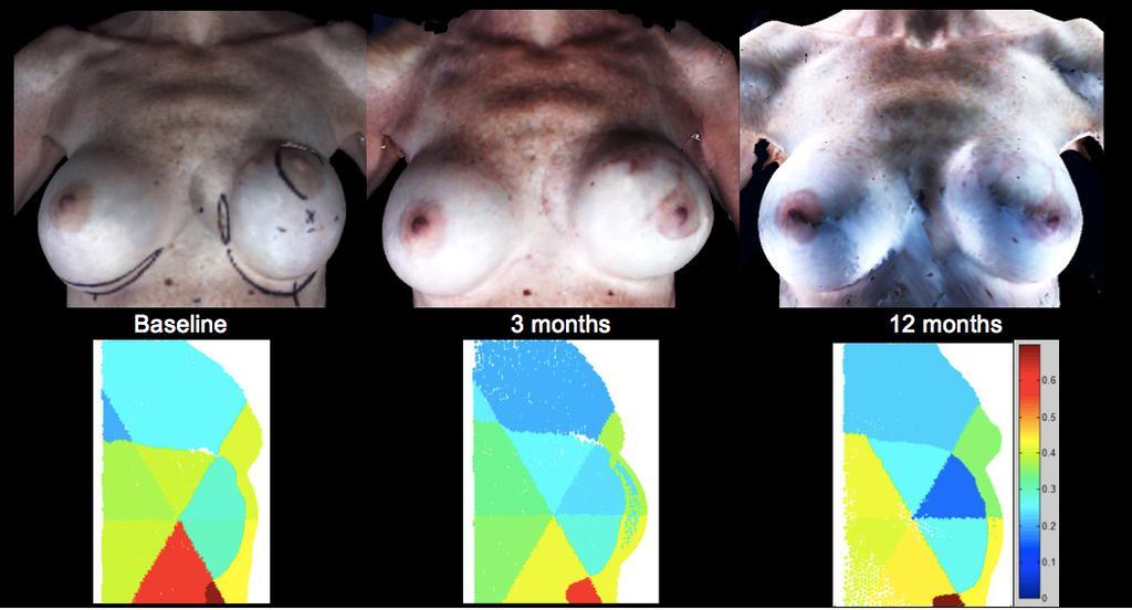 Figure 7. Patient E s images of the implant reconstructed left breast from baseline to 12 months postoperative (top row).