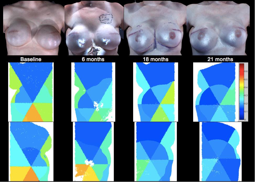 Patient F s images of the implant reconstructed breasts from baseline to 21 months postoperative (top row).
