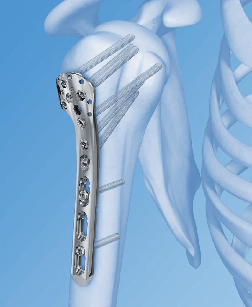 LCP Periarticular Proximal Humerus Plate 3.5. The anatomic fixation system with anterolateral shaft placement.