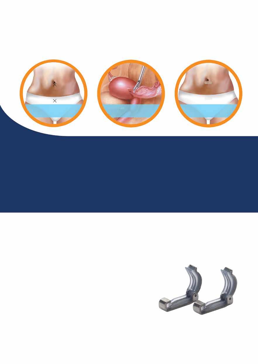 THE PROCEDURE The Filshie Clip procedure is usually performed under general anaesthetic and takes less than 30 minutes to perform. Patients may go home within 1-2 hours after the procedure.