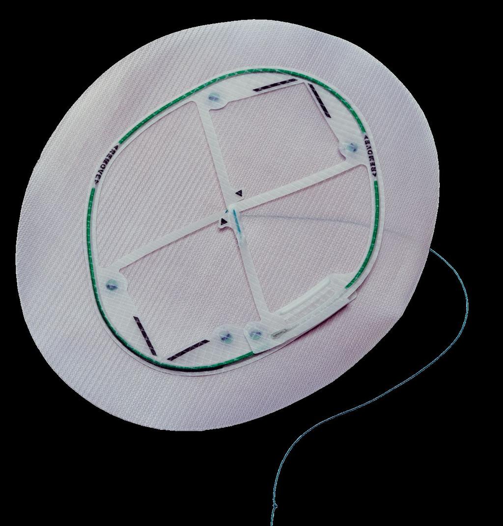 Designed for Accurate Mesh Centering and Overlap Monofilament polypropylene mesh with absorbable hydrogel barrier based on Sepra Technology with more than 10