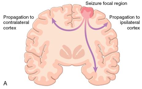 The seizures themselves may cause Some damage to the cortex; Loss of neurons, especially inhibitory neurons, has been demonstrated in tissue from seizure foci.