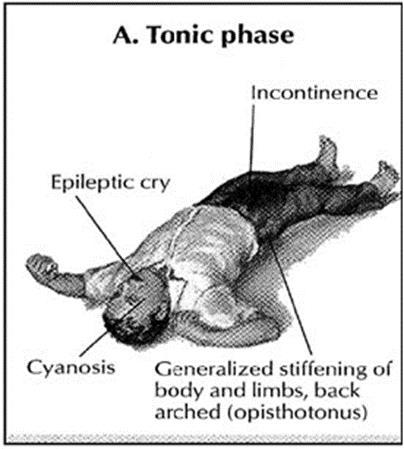 Generalized Tonic-Clonic (Grand Mal) Seizures) 1. Tonic-clonic: Characterized by: The duration of the seizure is usually 1 to 3 minutes. These seizures are often described as grand mal.