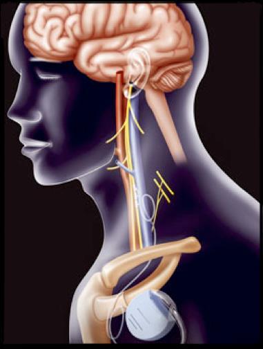 VNS stands for vagus nerve stimulation, a treatment that is sometimes called a pacemaker for the brain.