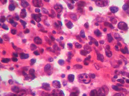 74 patterns in renal lymphoma include: multiple renal masses (with up to 60% of the cases), renal invasion from contiguous retroperitoneal disease (seen in 25 30% of cases), solitary masses (6% of