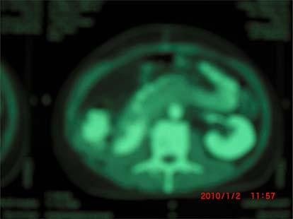 Abdominal CT scan, two weeks after