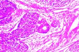 The WT1 gene is associated with Wilms Tumor An embryonic kidney tumor that exhibits a triphasic histology Consisting