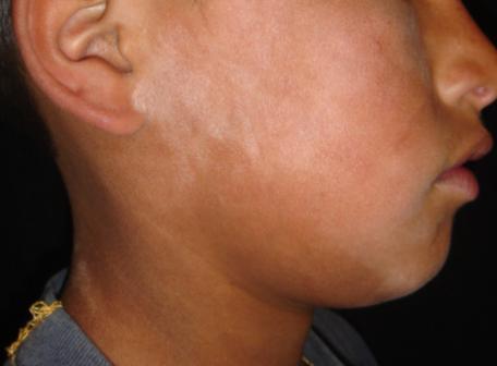 What is the most likely diagnosis? a. Pityriasis alba b.