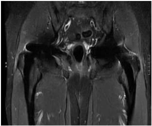 Imaging MRI: No evidence of pseudotumor/ AMR Intact gluteus medius/