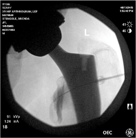 Case Presentation RT, 63yo M with L hip pain Received fluoroscopic-guided corticosteroid injection, which provided complete, temporary relief Background Anterior iliopsoas impingment (IPI) is a rare,