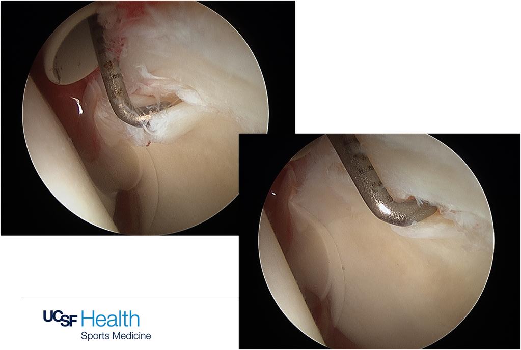 11/20/2017 Patient Studies demonstrate: Arthroscopic femoroplasty with labral repair in athletes result in significant