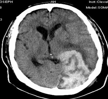 impairment, embolism with delayed reperfusion