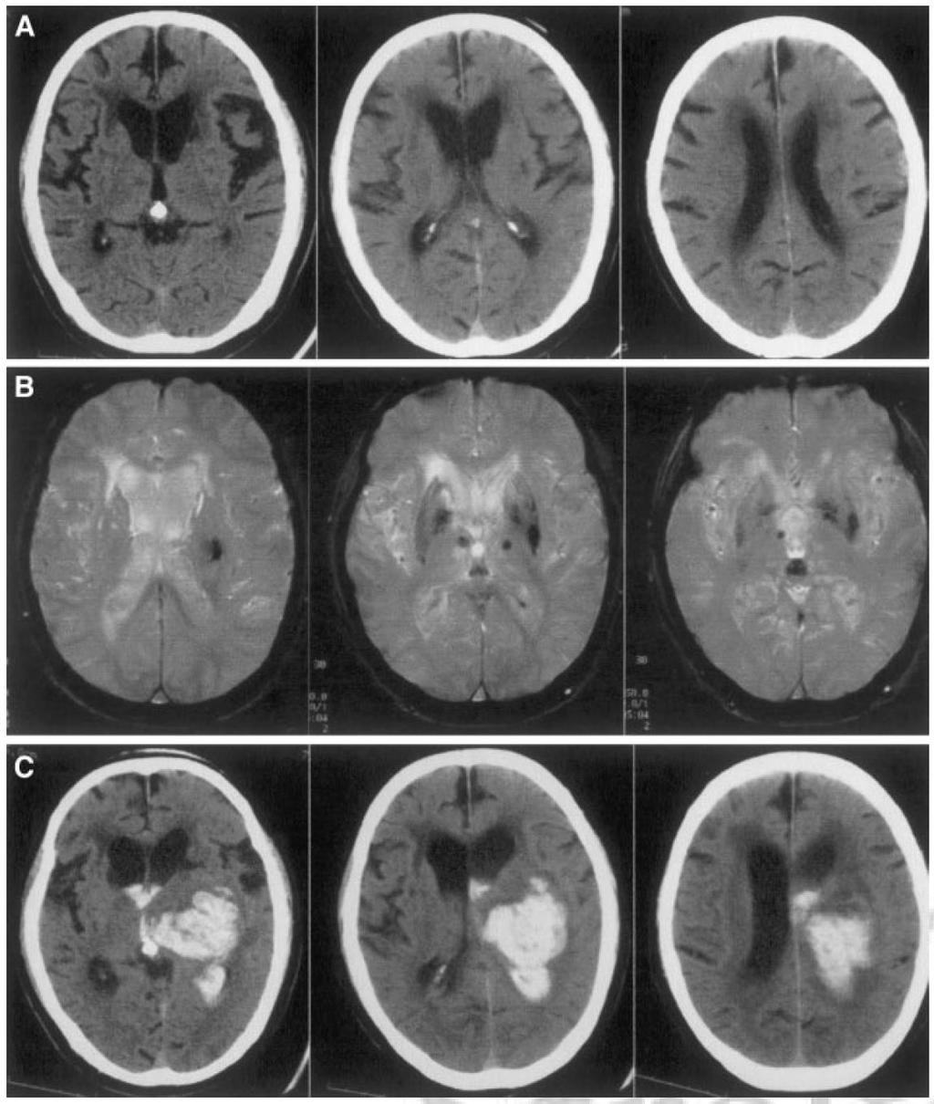 Incidental MRI Microbleeds and Risk of Stroke Meta-analysis of 5068 pts in 15 studies Incidental MB 10-35% Associated with microangiopathic small vessel white matter disease Increased risk of