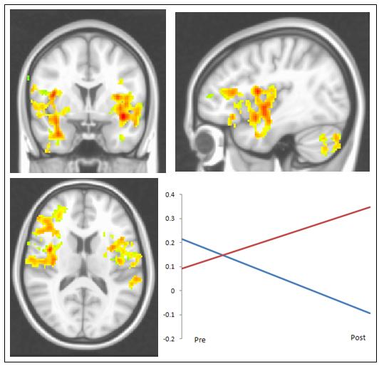 Resting State Functional Connectivity After Memory Retraining in MS Increased connectivity from L