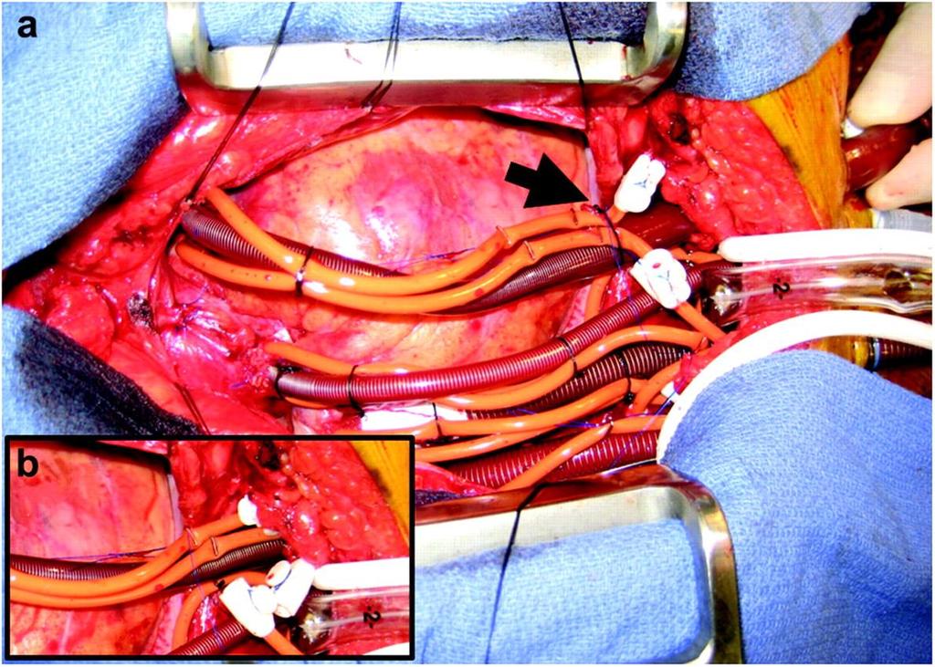 Bi Ventricular (a) Cannulation for CentriMag Assist BiVAD Device