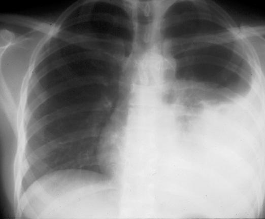 INFECTIOUSNESS OF TB Extrapulmonary TB is usually not infectious unless: Concomitant pulmonary disease TB in oral cavity or larynx Open
