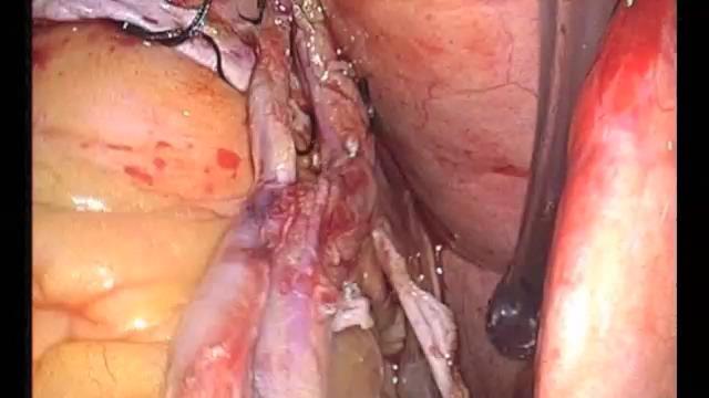 Clampless Total Arterial OPCABG X 5: BIMA + BRA LIMA & Radial 1, side-side Radial 1-end-side- D2