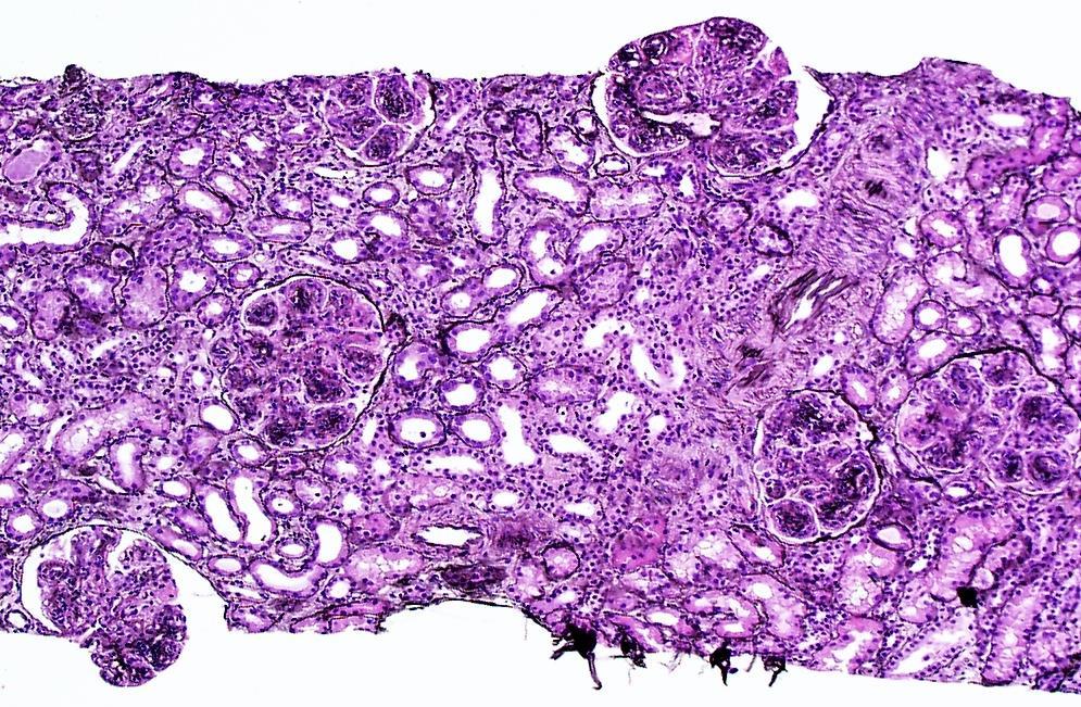Proliferative GN with monoclonal deposits (IgG3