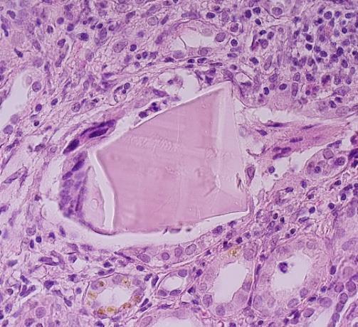 TIN associated with M protein cast nephropathy (historically called