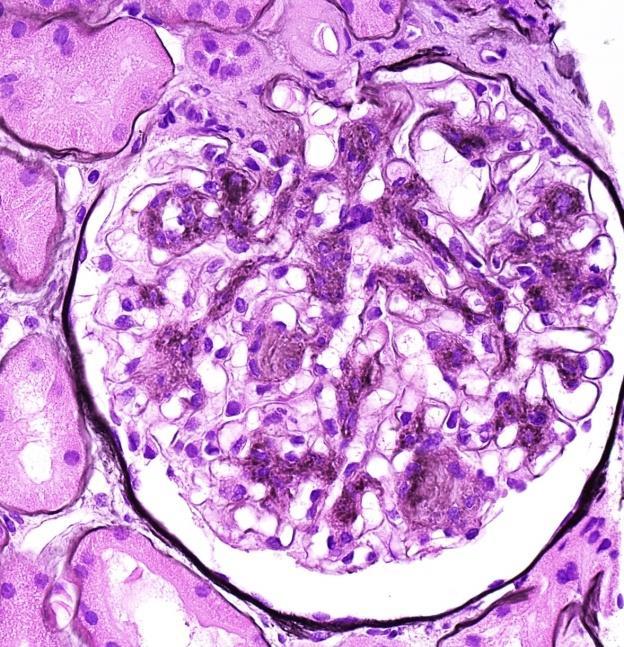 Combined patterns Combined patterns of glomerulopathic
