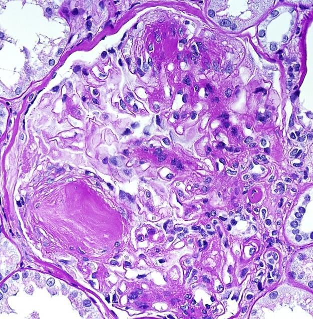 nephropathy, amyloidosis and LC cast nephropathy)