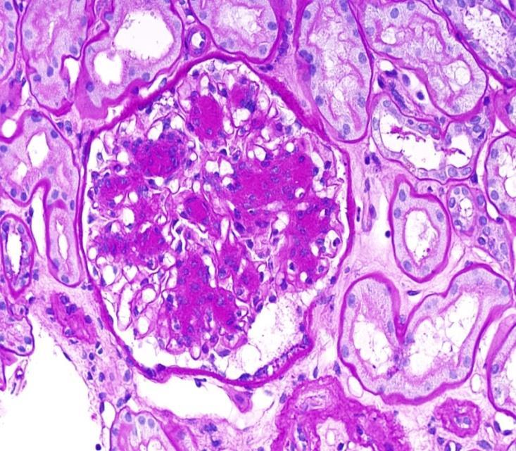 cell dyscrasias, differential diagnosis can be also