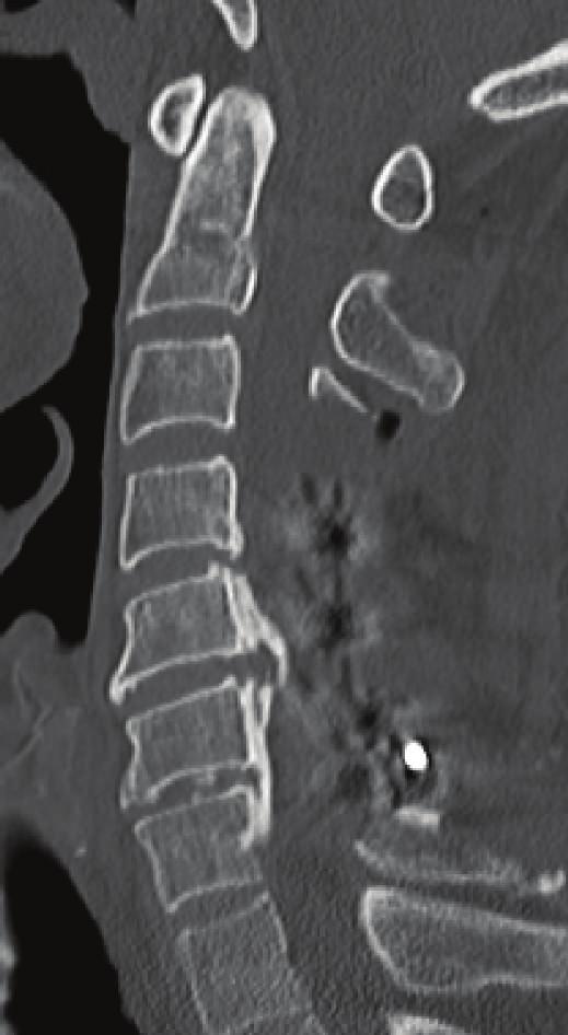 : there were no changes in anteroposterior diameters of the bilateral C4/5 foramen and no malposition of the screws on postoperative CT. (d): Additional bilateral foraminotomy at C4/5 was performed.